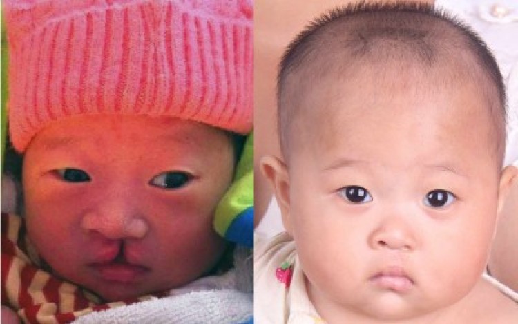 Hope for Cleft-Affected Children in Rural China