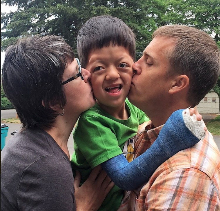 Adopting Our Son with Apert Syndrome