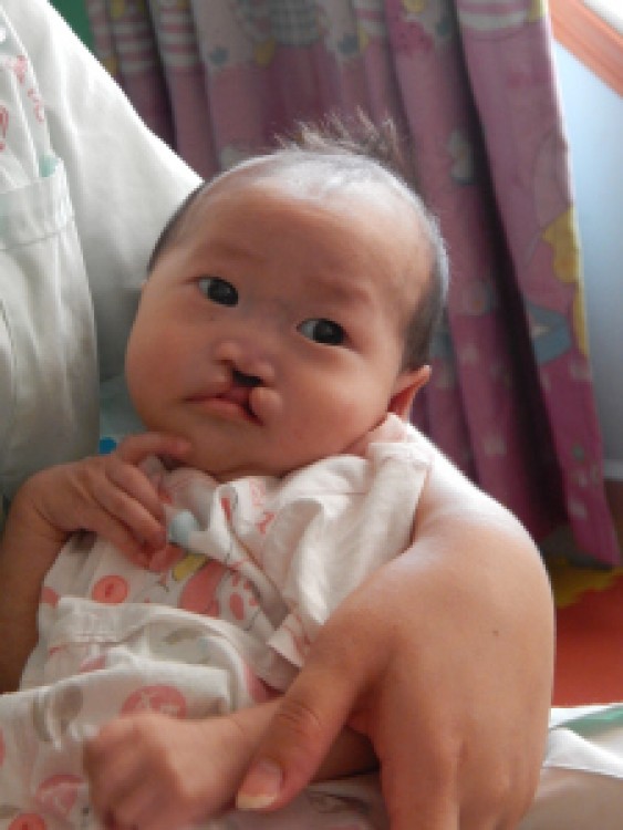 Adopting a Child with Cleft