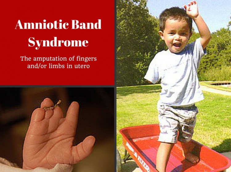 Adopting a Child with Amniotic Band Syndrome
