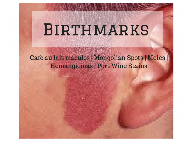 Birthmarks