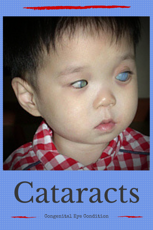 Adoption Referral: Cataracts