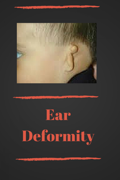 Ear Deformity