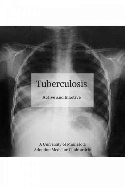 Adopting a Child with Tuberculosis: Active and Inactive